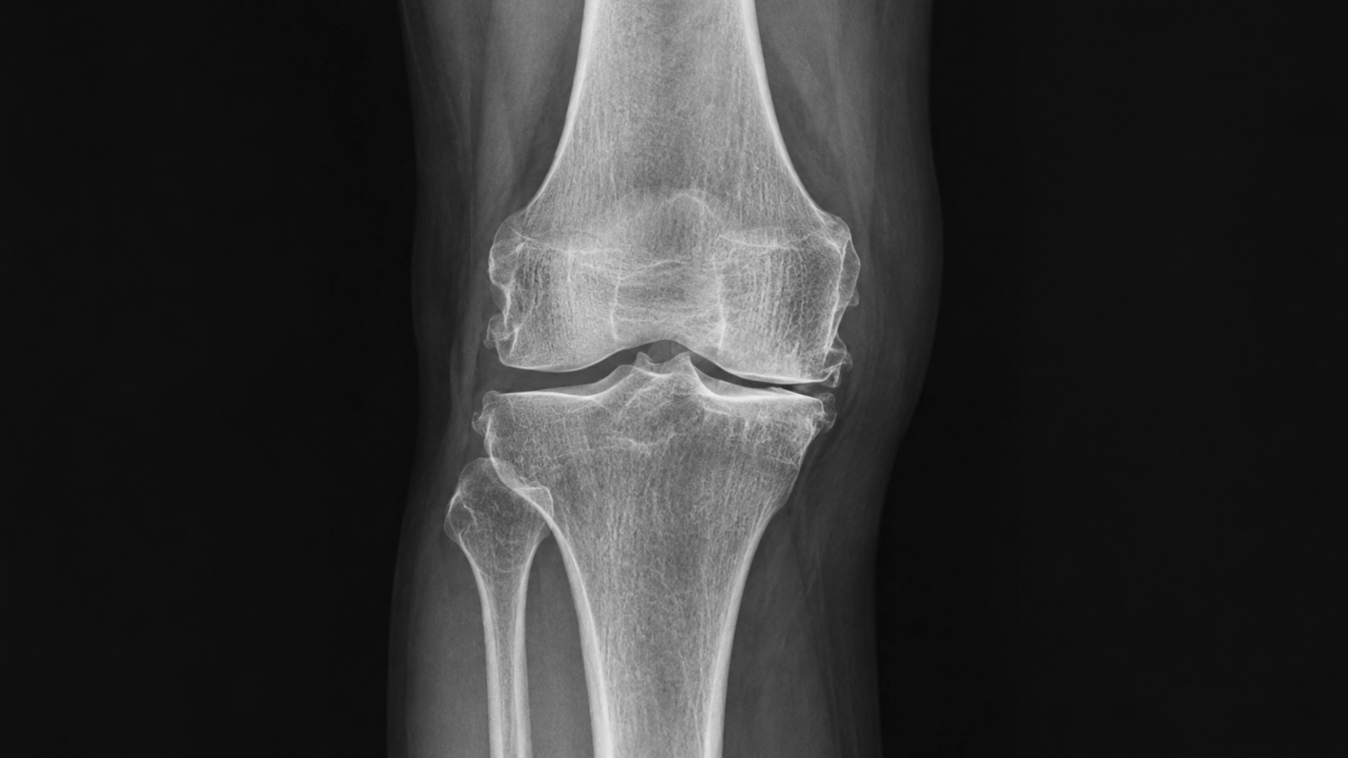 Radiografía y valoración de artrosis de rodilla grado 3